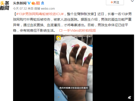 13歲男孩網(wǎng)購(gòu)毒蛇被咬進(jìn)ICU 整個(gè)左臂腫脹發(fā)紫